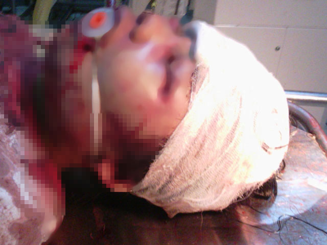 Hình ảnh Bé gái 14 tuổi bị đánh vô cùng dã man trong đêm số 1