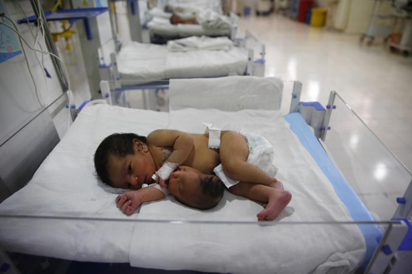 Bé gái sơ sinh có đầu mọc ra từ bụng ở Ấn Độ