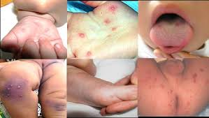 Bệnh chân tay miệng: Triệu chứng, điều trị và cách phòng ngừa