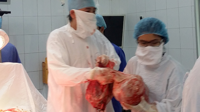 Nam Định: Thầy lang phán có thai, mổ ra khối u nặng 23kg