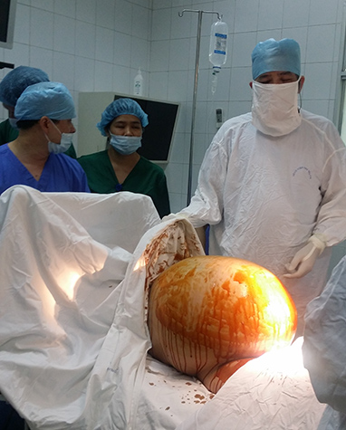Nam Định: Thầy lang phán có thai, mổ ra khối u nặng 23kg