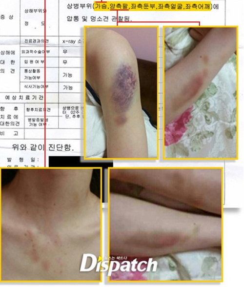 Bạn gái Kim Hyun Joong công khai hình ảnh bị đánh thương tích đầy mình 5