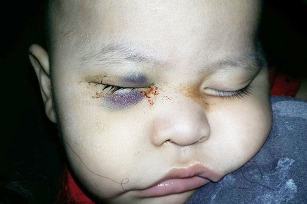 Bé 1 tuổi bị mù vì bác sĩ phẫu thuật nhầm mắt 1