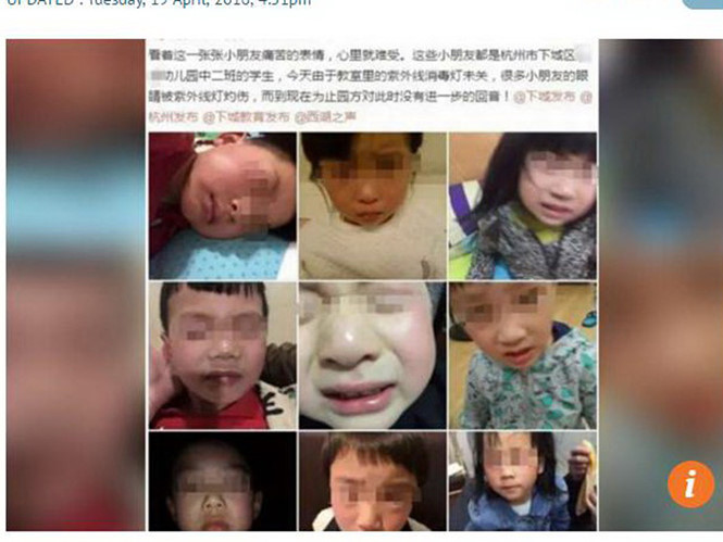 Giáo viên bất cẩn, 8 trẻ mẫu giáo Trung Quốc bị bỏng mắt 1