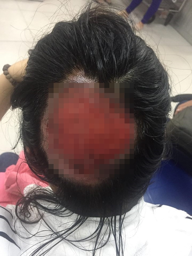 Tai nạn nghiêm trọng khi uốn tóc: Tóc cuốn vào ống dẫn nhiệt, nữ bác sĩ bỏng sâu, tróc gần như toàn bộ da đầu - Ảnh 1.