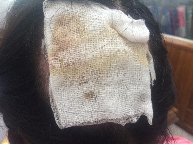 Tai nạn nghiêm trọng khi uốn tóc: Tóc cuốn vào ống dẫn nhiệt, nữ bác sĩ bỏng sâu, tróc gần như toàn bộ da đầu - Ảnh 2.