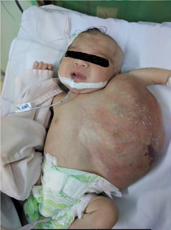 TP.HCM: Vừa chào đời, bé gái đã mang khối u khủng trên cơ thể khiến tính mạng nguy hiểm - Ảnh 3.