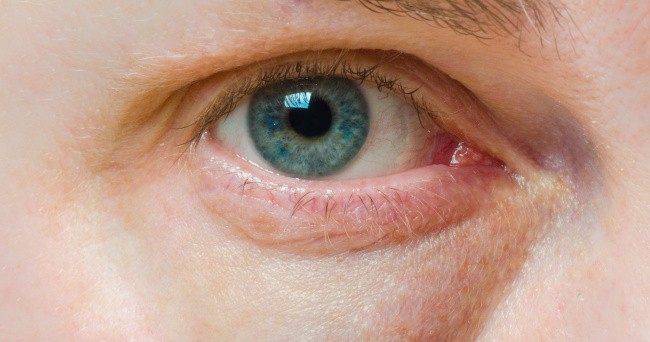 Có thể bị mù vĩnh viễn nếu mắt có dấu hiệu này mà mặc kệ không đi khám - Ảnh 5.