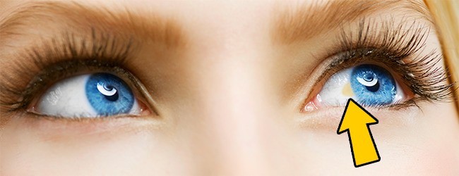 Có thể bị mù vĩnh viễn nếu mắt có dấu hiệu này mà mặc kệ không đi khám - Ảnh 6.