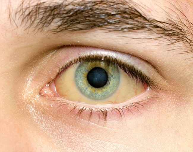 Có thể bị mù vĩnh viễn nếu mắt có dấu hiệu này mà mặc kệ không đi khám - Ảnh 10.