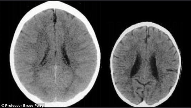 Ảnh chụp CT não của 2 em bé khác nhau khiến bố mẹ giật mình về cách dạy con - Ảnh 1.