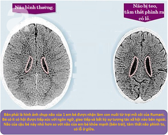 Ảnh chụp CT não của 2 em bé khác nhau khiến bố mẹ giật mình về cách dạy con - Ảnh 2.