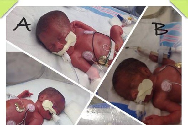 Bà mẹ 42 tuổi được chẩn đoán sinh ba, đến ngày sinh, điều bất ngờ đến nín thở đã xảy ra - Ảnh 1.