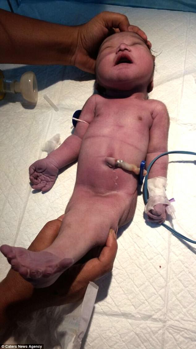 Em bé sơ sinh bị mắc dị tật dính liền chân giống như người cá trong truyền thuyết - Ảnh 2.
