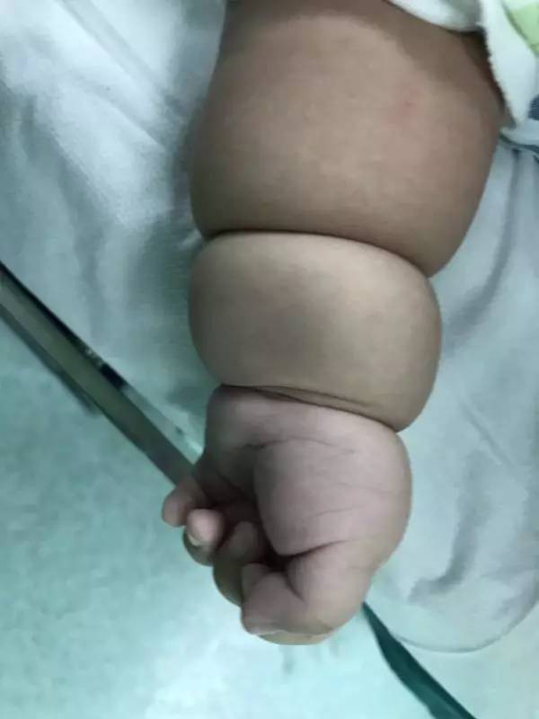 Con mới sinh tay chân đã có nhiều ngấn, bố toát mồ hôi khi bác sĩ nói để muộn phải cắt bỏ - Ảnh 4.