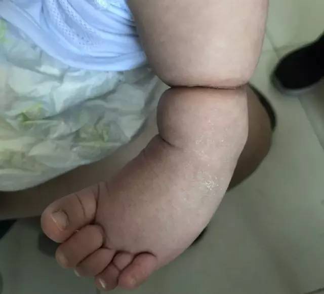 Con mới sinh tay chân đã có nhiều ngấn, bố toát mồ hôi khi bác sĩ nói để muộn phải cắt bỏ - Ảnh 9.