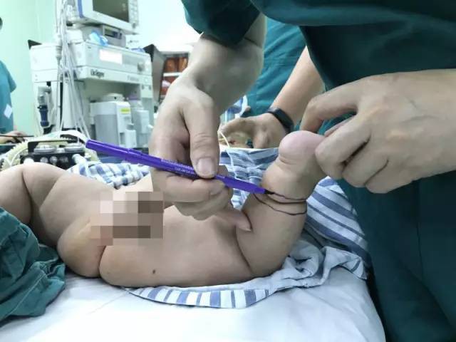 Con mới sinh tay chân đã có nhiều ngấn, bố toát mồ hôi khi bác sĩ nói để muộn phải cắt bỏ - Ảnh 5.