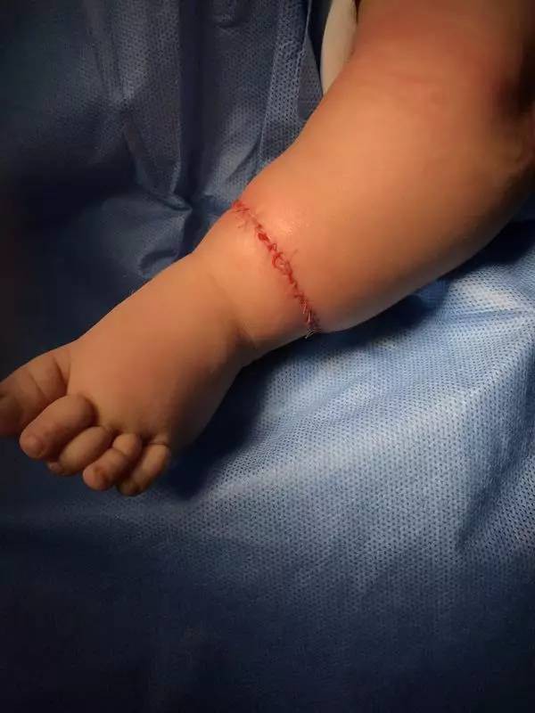 Con mới sinh tay chân đã có nhiều ngấn, bố toát mồ hôi khi bác sĩ nói để muộn phải cắt bỏ - Ảnh 7.