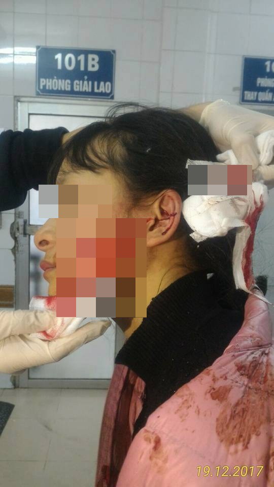 Nữ sinh bất ngờ bị đâm rách 14cm ở mặt do mâu thuẫn vì bán quần áo trên mạng - Ảnh 1.