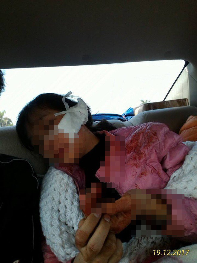 Nữ sinh bất ngờ bị đâm rách 14cm ở mặt do mâu thuẫn vì bán quần áo trên mạng - Ảnh 2.