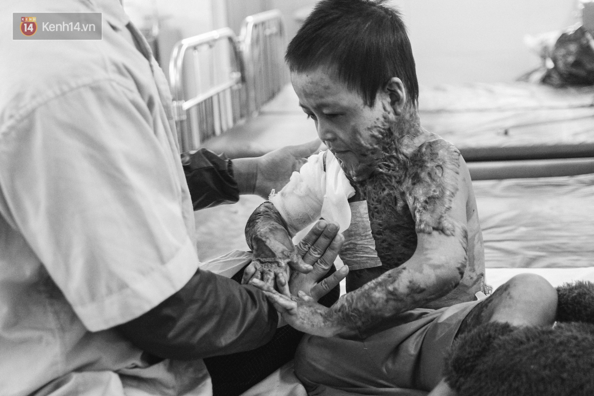 Xót xa những vết bỏng đau đớn trên người bé trai 6 tuổi: Ngày con phải cưa chân là ngày bạn bè vào lớp 1 - Ảnh 4. Xót xa những vết bỏng đau đớn trên người bé trai 6 tuổi: Ngày con phải cưa chân là ngày bạn bè vào lớp 1 4