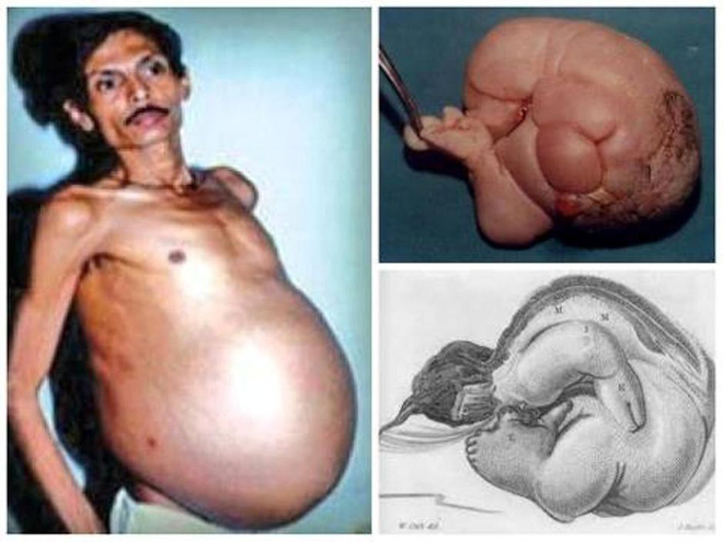 Chuyện lạ về người đàn ông mang thai suốt 36 năm ở Ấn Độ - Ảnh 1.
