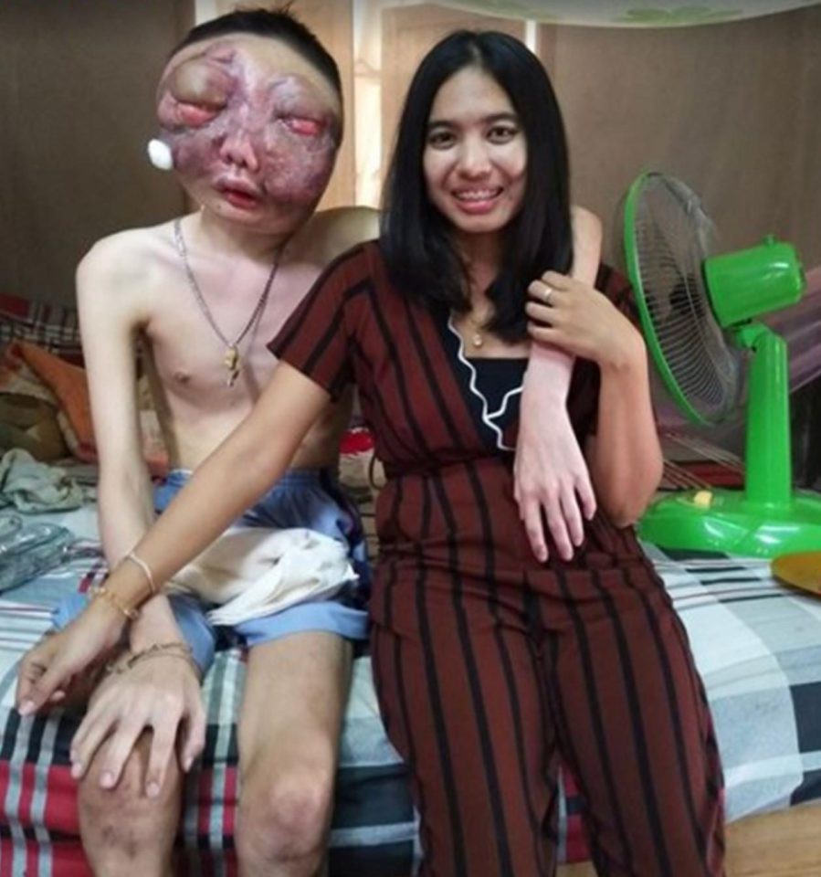 Dù chồng bị ung thư với khuôn mặt biến dạng, vợ vẫn một lòng ở bên chăm sóc: 3 năm, em vẫn yêu anh như ngày đầu - Ảnh 3. Dù chồng bị ung thư với khuôn mặt biến dạng, vợ vẫn một lòng ở bên chăm sóc: '3 năm, em vẫn yêu anh như ngày đầu' 3