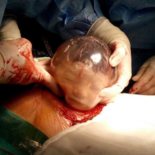 Ngắm khoảnh khắc kì diệu khi em bé còn nằm nguyên trong túi ối từ từ nhích ra khỏi bụng mẹ - Ảnh 2.
