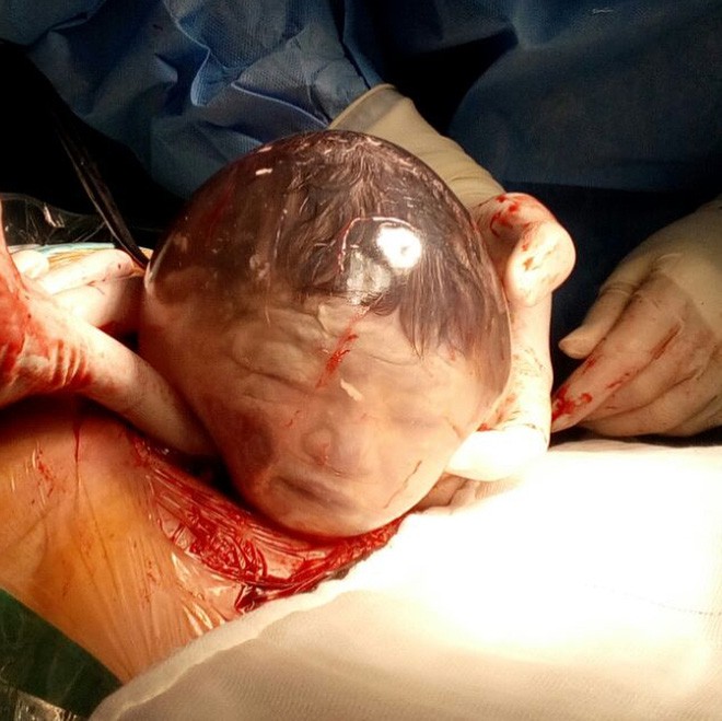 Ngắm khoảnh khắc kì diệu khi em bé còn nằm nguyên trong túi ối từ từ nhích ra khỏi bụng mẹ - Ảnh 3.