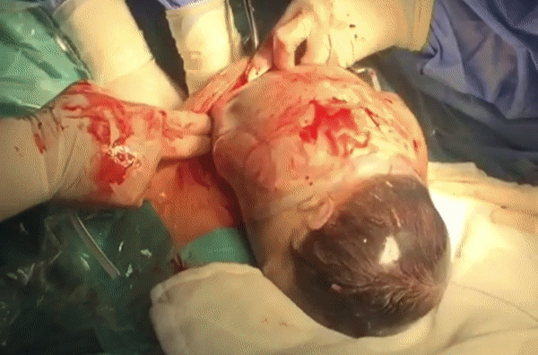 Ngắm khoảnh khắc kì diệu khi em bé còn nằm nguyên trong túi ối từ từ nhích ra khỏi bụng mẹ - Ảnh 4.