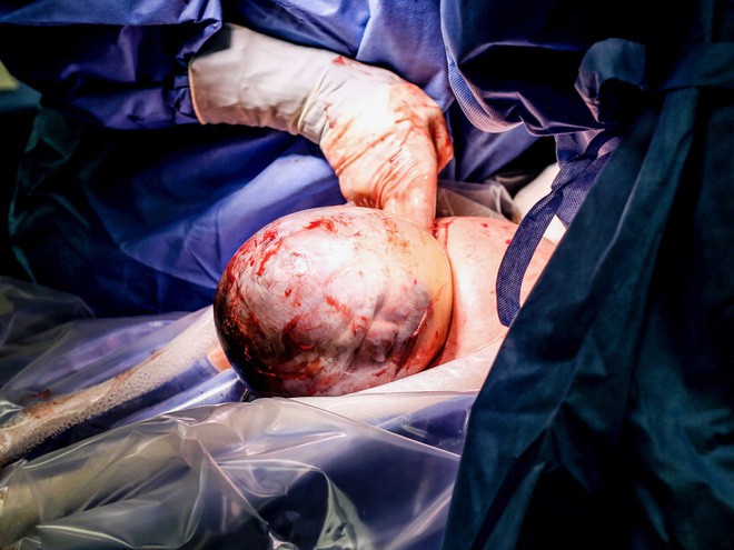 Ngắm khoảnh khắc kì diệu khi em bé còn nằm nguyên trong túi ối từ từ nhích ra khỏi bụng mẹ - Ảnh 9.