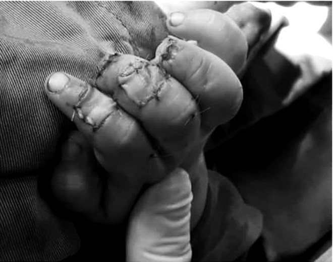 Đưa tay vào khe cửa sắt, bé trai hai tuổi ở Đồng Nai bị kẹp đứt đầu ngón tay - Ảnh 1.