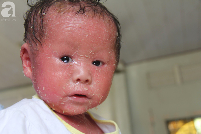 Người đầy vẩy ngứa như da trăn, bé gái 16 tháng tuổi bị bố mẹ bỏ rơi nên không có tiền chữa trị - Ảnh 12. Người đầy vẩy ngứa như da trăn, bé gái 16 tháng tuổi bị bố mẹ bỏ rơi nên không có tiền chữa trị 12