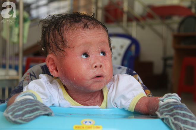 Người đầy vẩy ngứa như da trăn, bé gái 16 tháng tuổi bị bố mẹ bỏ rơi nên không có tiền chữa trị - Ảnh 13. Người đầy vẩy ngứa như da trăn, bé gái 16 tháng tuổi bị bố mẹ bỏ rơi nên không có tiền chữa trị 13