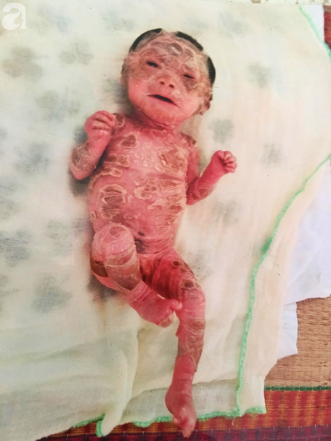 Người đầy vẩy ngứa như da trăn, bé gái 16 tháng tuổi bị bố mẹ bỏ rơi nên không có tiền chữa trị - Ảnh 5. Người đầy vẩy ngứa như da trăn, bé gái 16 tháng tuổi bị bố mẹ bỏ rơi nên không có tiền chữa trị 5