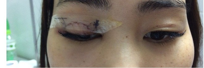 Bác sĩ BV Mắt trung ương kể chuyện vã mồ hôi phẫu thuật cho cô gái bị kim chui vào mí mắt 1