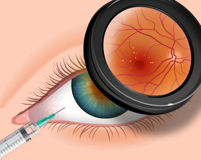 4 căn bệnh ở mắt nếu không chữa trị sớm có thể dẫn tới nguy cơ mù lòa - Ảnh 1.
