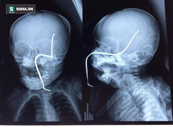 Tai nạn hy hữu: Bé 8 tháng tuổi đang chơi ở sân bị thanh sắt rỉ bắn thẳng vào hộp sọ - Ảnh 1.