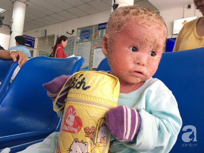 Ca sĩ Lam Trường đến thăm bé Bích - em bé bị vẩy ngứa da trăn trước khi bé nhập viện điều trị - Ảnh 2.