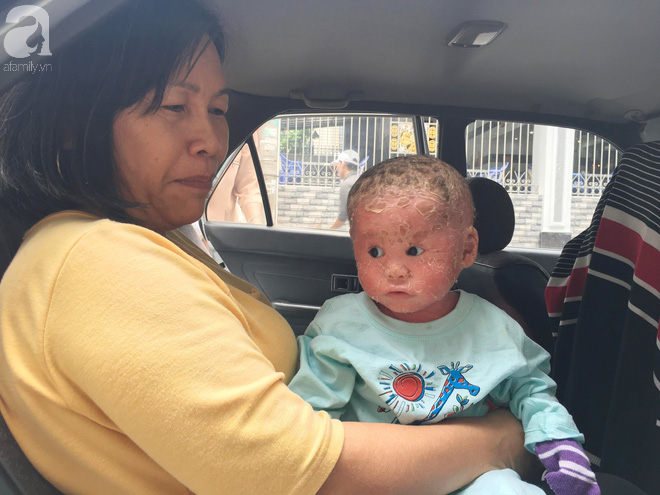 Ca sĩ Lam Trường đến thăm bé Bích - em bé bị vẩy ngứa da trăn trước khi bé nhập viện điều trị - Ảnh 9.