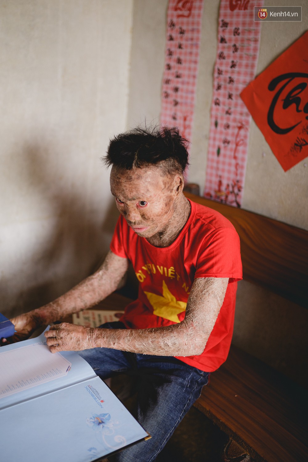 Chàng trai người cá lạc quan ở Hà Nội: Nhìn thấy bộ dạng của mình, nhiều người hỏi sao không chết đi, sống để làm gì? - Ảnh 1.