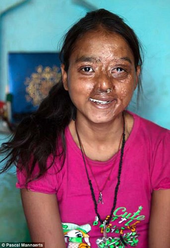 Ám ảnh gương mặt bị tàn phá kinh hoàng vì axit của phụ nữ Ấn Độ - Ảnh 5.