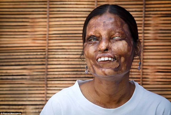 Ám ảnh gương mặt bị tàn phá kinh hoàng vì axit của phụ nữ Ấn Độ - Ảnh 7.