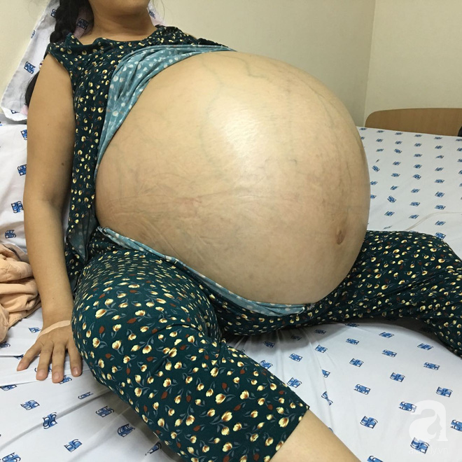6 giờ ròng rã cứu mạng người phụ nữ mang khối u buồng trứng lớn nhất Việt Nam - Ảnh 1.