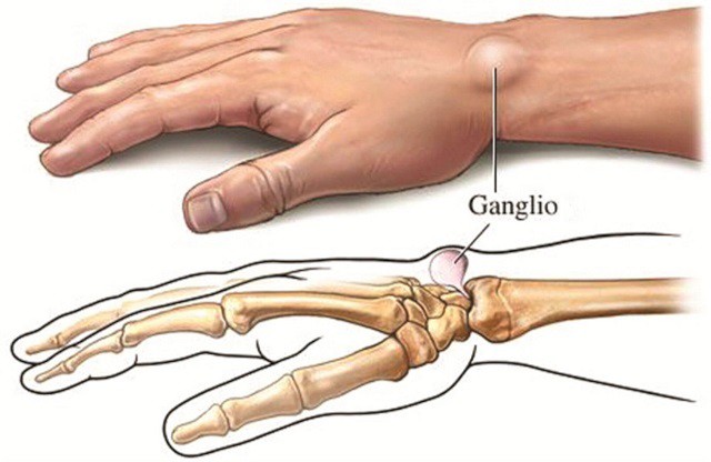 Xuất hiện cục u nổi bất thường ở cổ tay: Đừng bỏ qua vì đó có thể là dấu hiệu cảnh báo bệnh nguy hiểm - Ảnh 2.