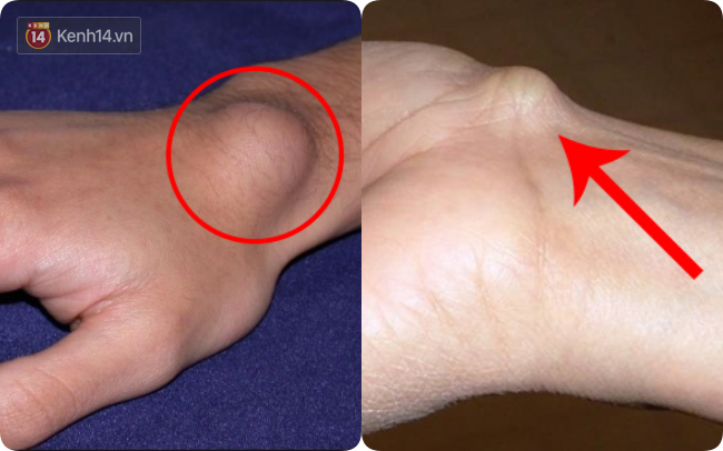 Xuất hiện cục u nổi bất thường ở cổ tay: Đừng bỏ qua vì đó có thể là dấu hiệu cảnh báo bệnh nguy hiểm - Ảnh 1.