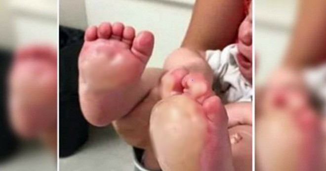Mỹ: Tức giận vì bé 6 tháng tuổi quấy khóc, bảo mẫu nhẫn tâm nhúng 2 bàn chân bé vào chảo dầu sôi - Ảnh 1.
