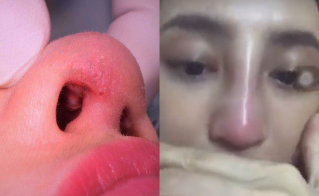 Nâng mũi bằng sụn nhân tạo, cô gái xinh đẹp bị nhiễm trùng mưng mủ gần nửa năm, chịu bao đau đớn để phục hồi nhan sắc - Ảnh 2.