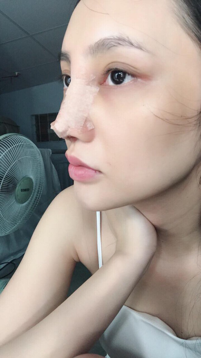 Nâng mũi bằng sụn nhân tạo, cô gái xinh đẹp bị nhiễm trùng mưng mủ gần nửa năm, chịu bao đau đớn để phục hồi nhan sắc - Ảnh 9.