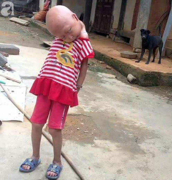 Tuyên Quang: 2 chị em gái mắc bệnh lạ khiến đầu, cổ bị nghẹo tựa người ngoài hành tinh khiến ai nhìn cũng xót xa - Ảnh 5. Tuyên Quang: 2 chị em gái mắc bệnh lạ khiến đầu, cổ bị nghẹo tựa 'người ngoài hành tinh' khiến ai nhìn cũng xót xa 4
